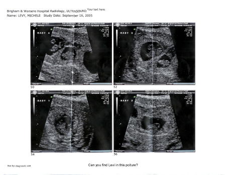 Ultrasound 2 Sept 16
